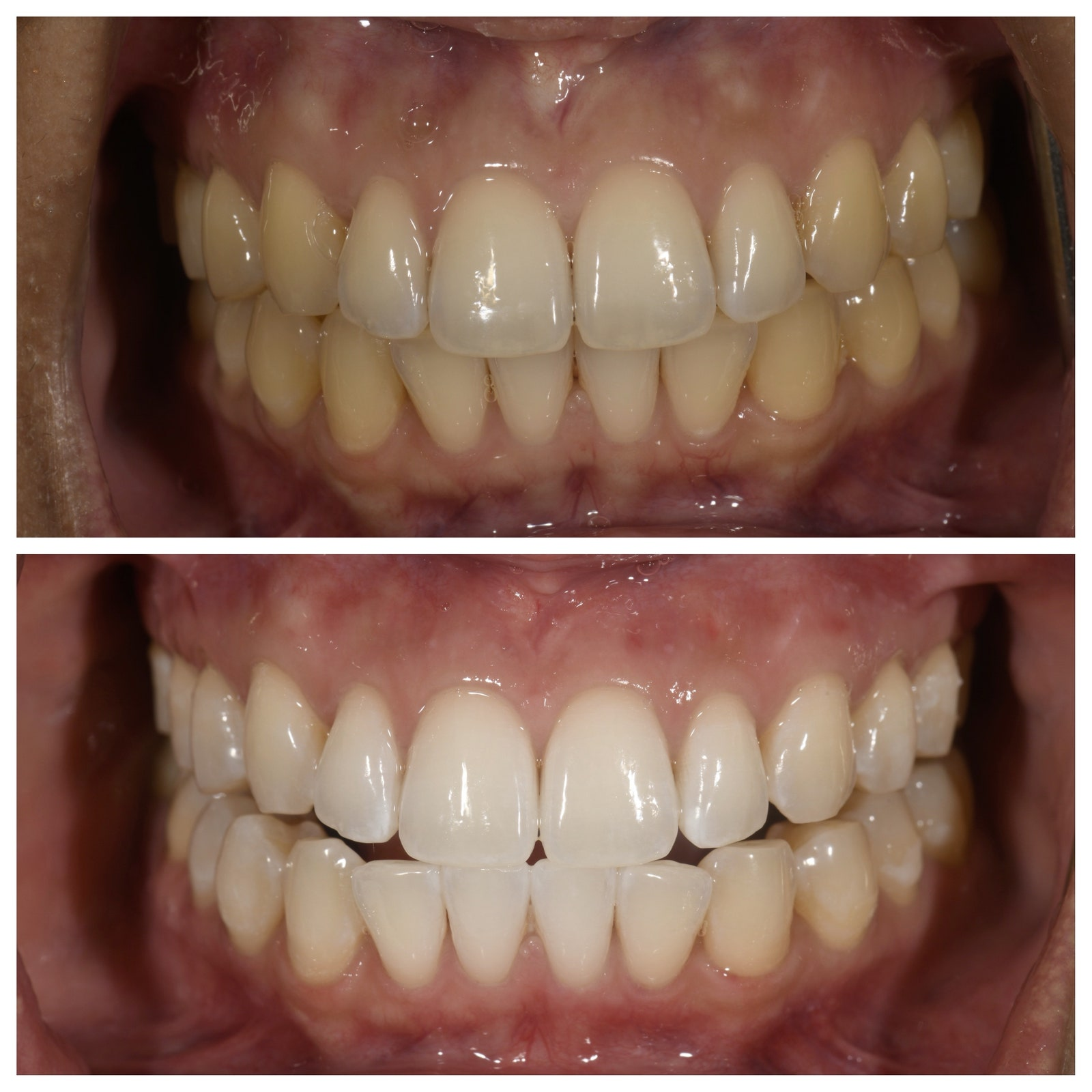 BrightWhite™ | Slip kraften i et lysere smil løs