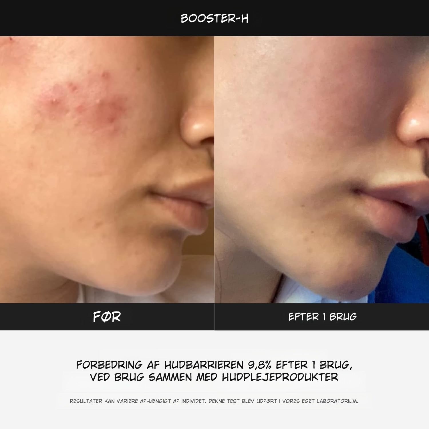 LumaBooster™ | Avanceret Hudpleje til Bedre Hudstruktur og Aknebehandling